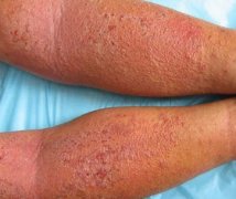 �ɶ���������ʪ����ʲôԤ�������ķ�����