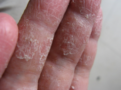 ����Ѣ��Ҫ����Щ֢״��