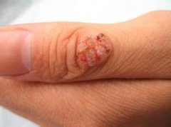 Ѱ������Ϯ�������Щ֢״���֣�