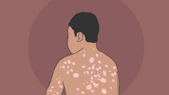 �ɶ��ĸ�ҽԺ��ţƤѢ�Ϻ�